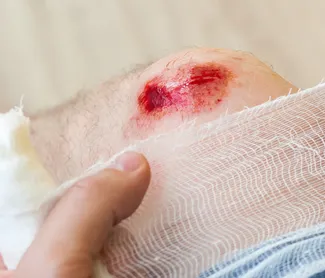 Laceration vs. Skin Tear vs. Abrasion: Know the difference